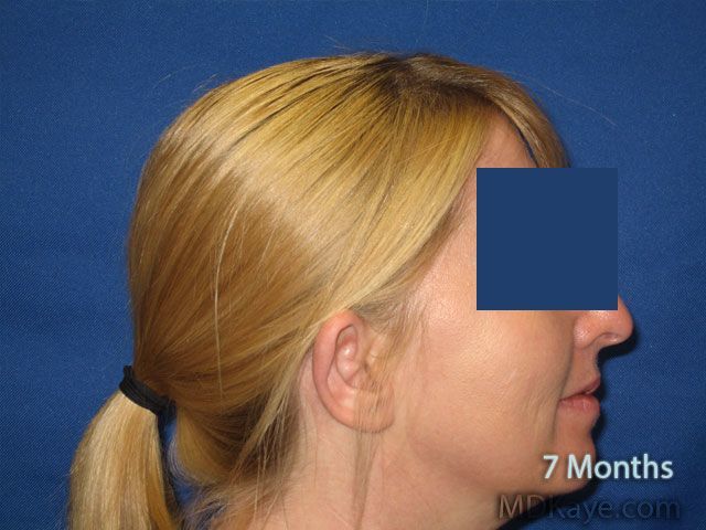 Ear Surgery (Otoplasty)