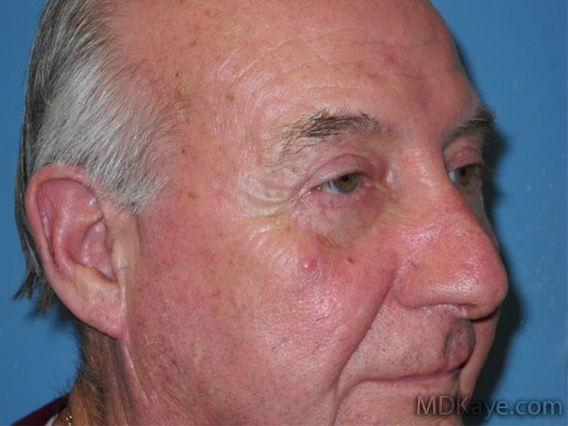Eyelid Surgery for Men