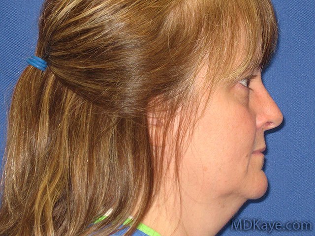 Face Lift (Rhytidectomy)