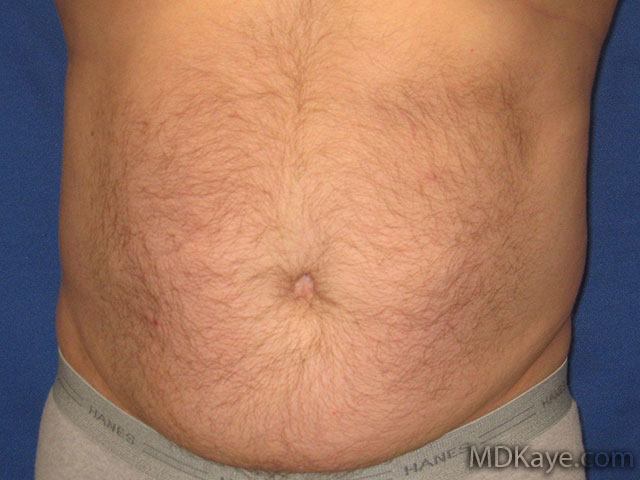 Liposuction For Men