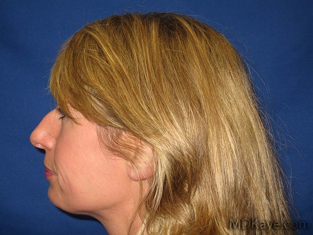 Nose Job (Rhinoplasty)