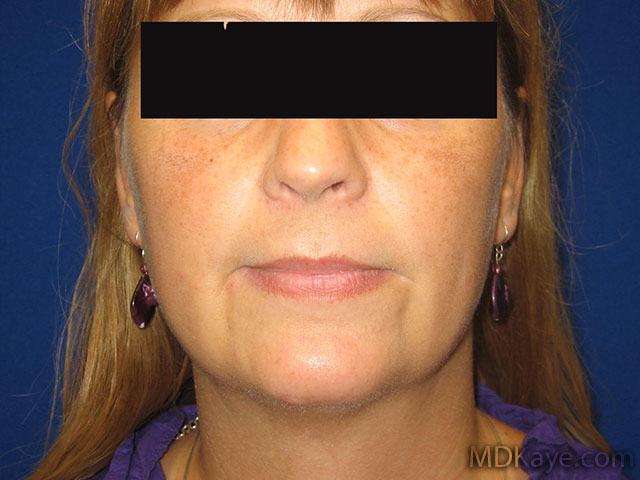 Chin Augmentation or Chin Implant Results Hopkinsville