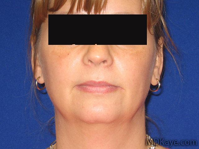 Chin Augmentation or Chin Implant Results Hopkinsville