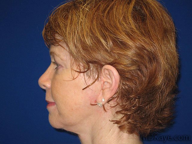 Sideview of a woman after fat transfer or grafting