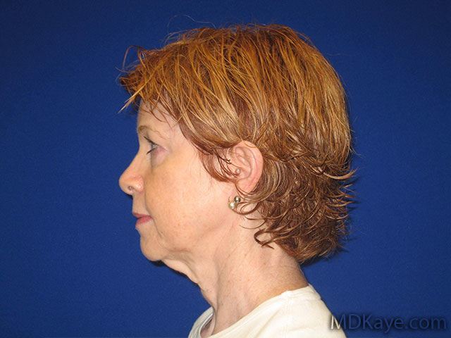 Sideview of a woman before fat transfer or grafting