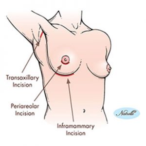Three Basic Choices for the Incision to Perform Breast Augmentation
