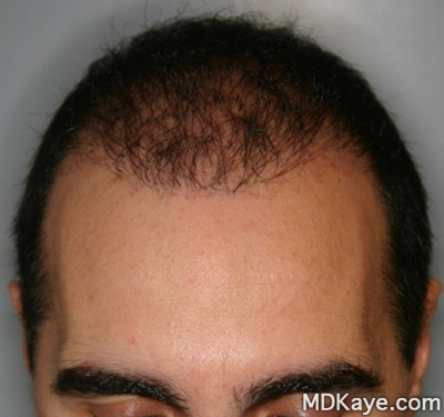 NeoGraft® Hair Restoration