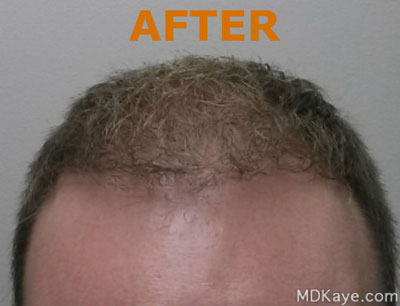NeoGraft® Hair Restoration