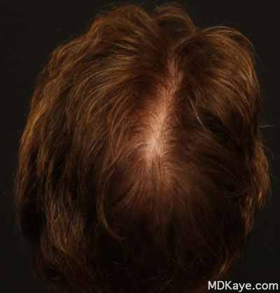 NeoGraft® Hair Restoration for Women