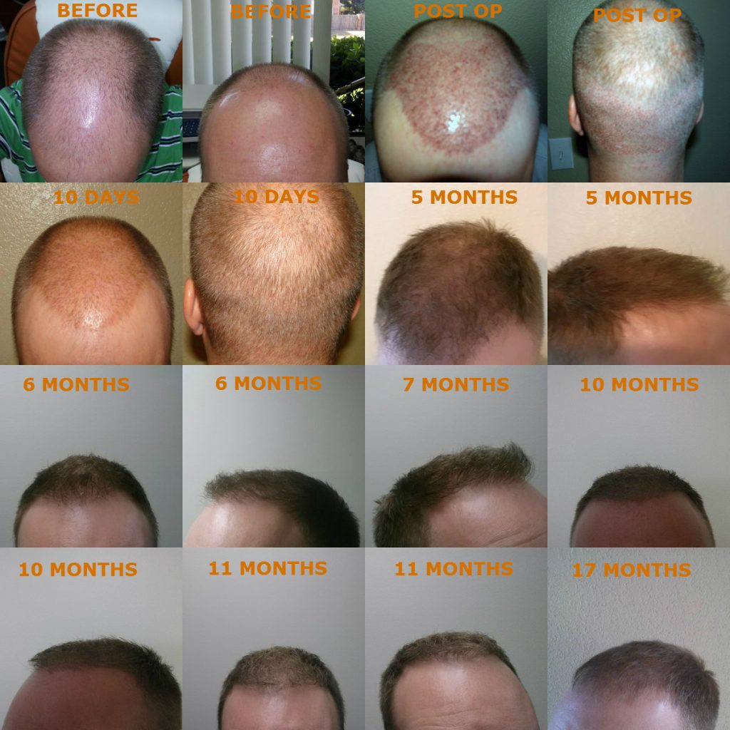 Neograft Hair Restoration Hopkinsville, KY | Male Surgery KY