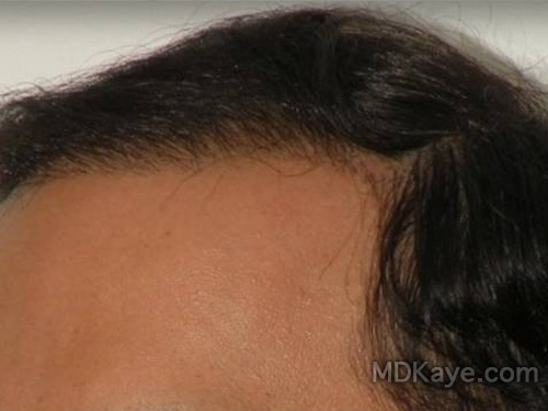 Neograft Hair Restoration Results Hopkinsville KY